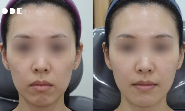 How Long Does Juvelook Volume Last? A Real Longevity Guide