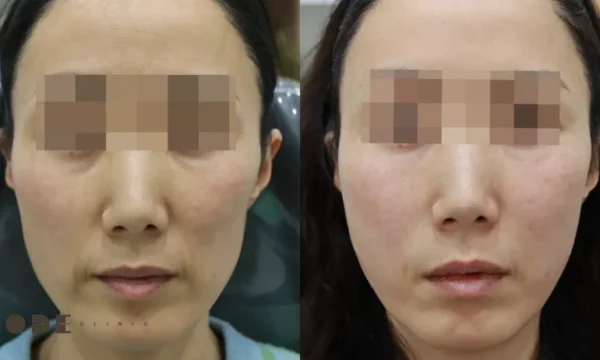 The “Peanut-Shaped” Face: What Causes Sunken Cheeks—and How We Treat It (Expert Guide)