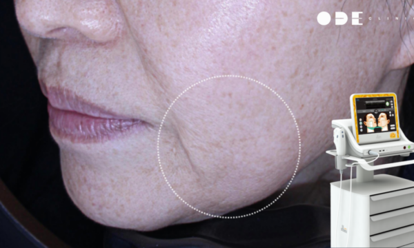 Does Ultherapy Really Work for Jowls? What You Need to Know