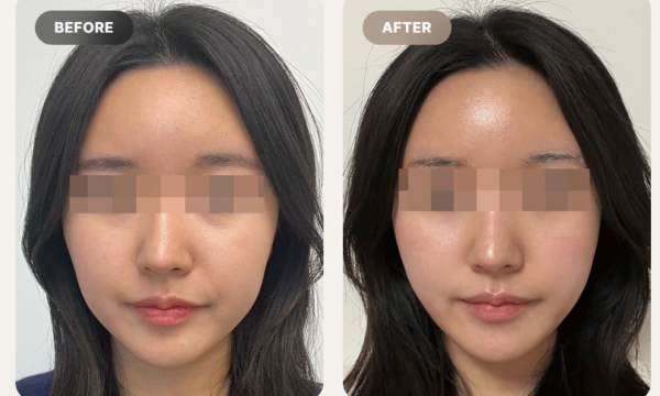 Ultherapy Cost & Price in Seoul, Korea: Complete Guide and Why Prices Vary