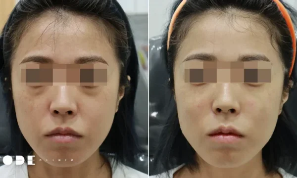 Midface Case: Tear Trough Filler, Anterior Cheek Filler, and Nasolabial Radiesse — Before & After