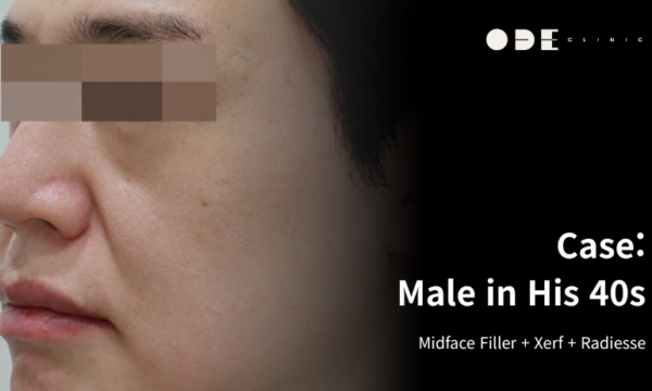 Midface Looking Longer? Anterior Cheek Filler + XERF + Radiesse — Results, Before & After, Review